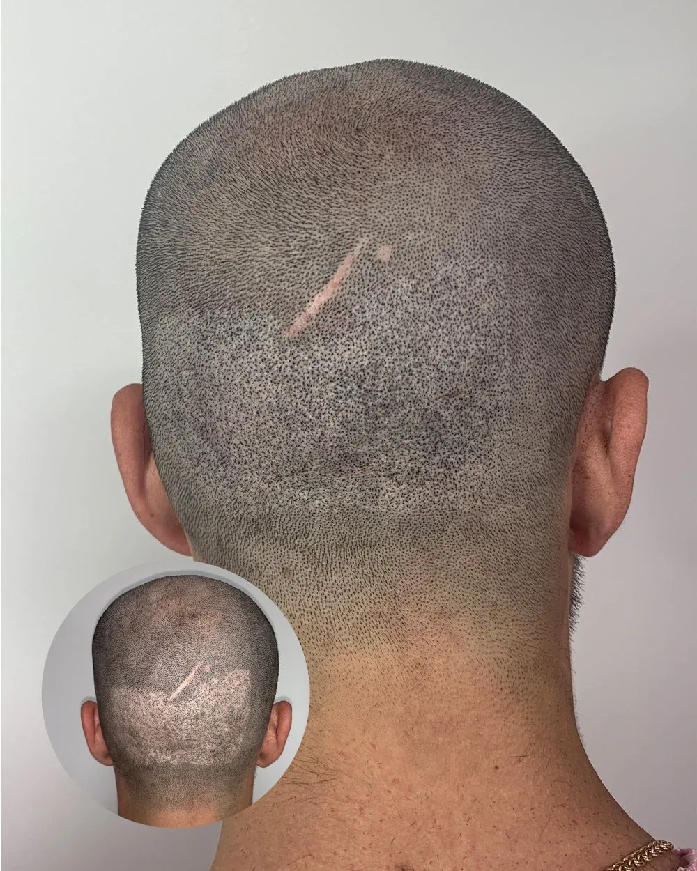 Hairline restoration before and after — male client