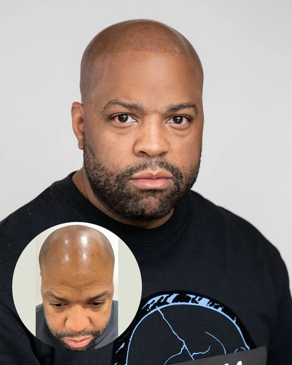 Hairline restoration before and after — male client