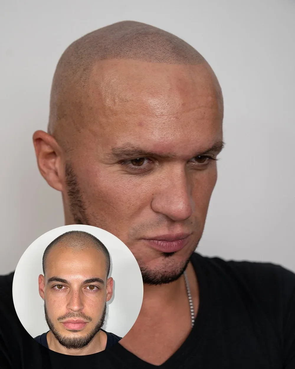 Hairline restoration before and after — male client