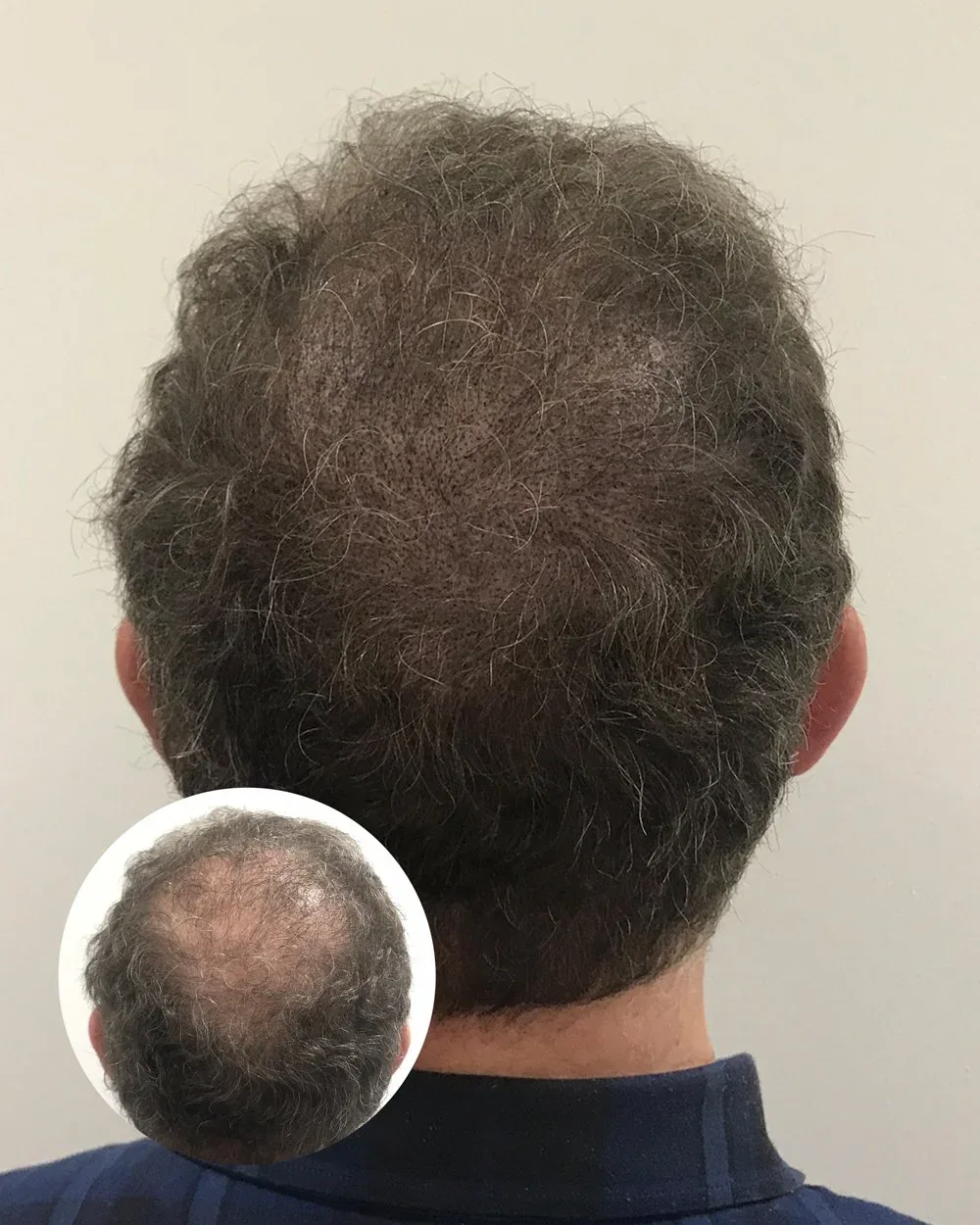 Density treatment before and after — male client