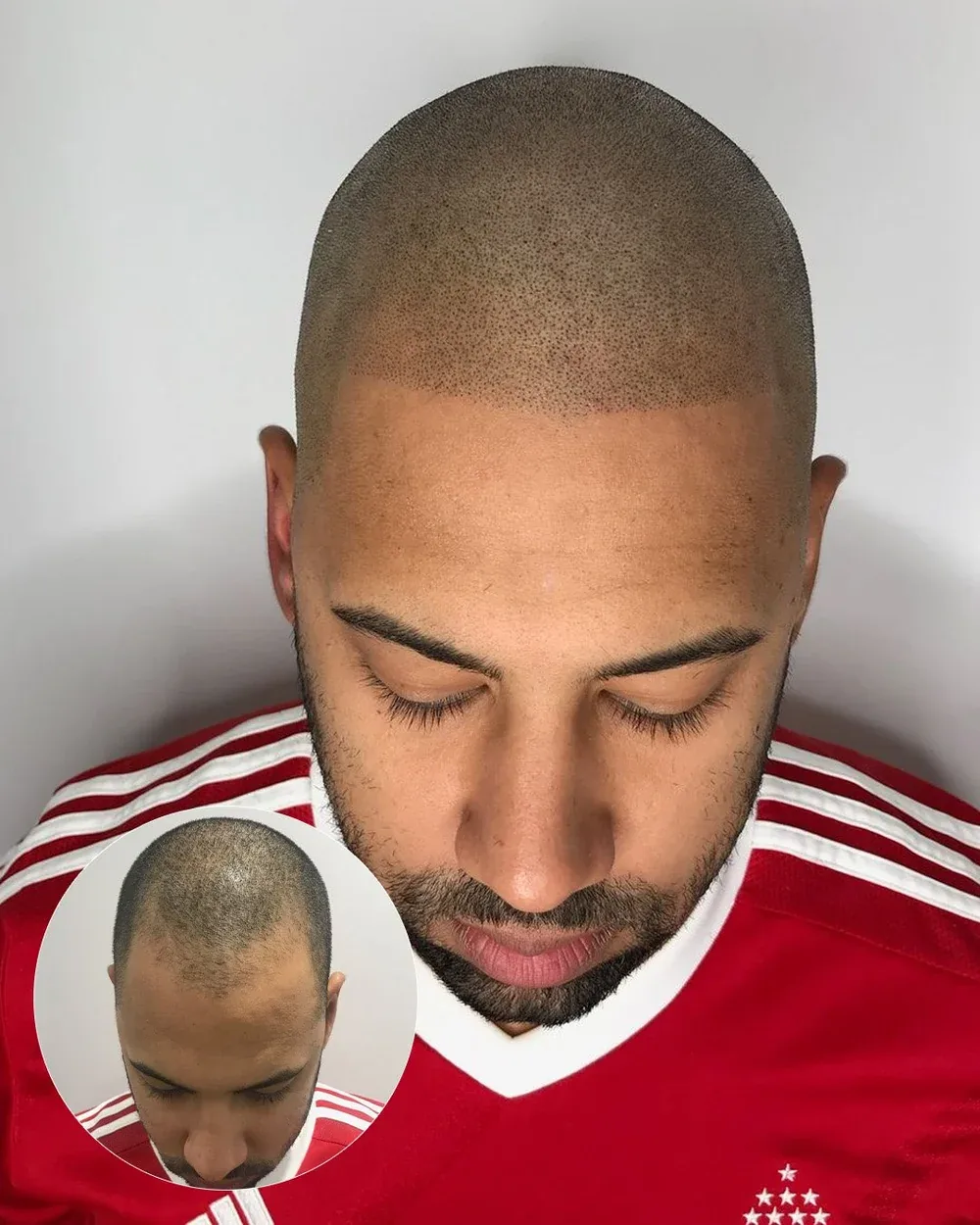 Hairline restoration before and after — male client