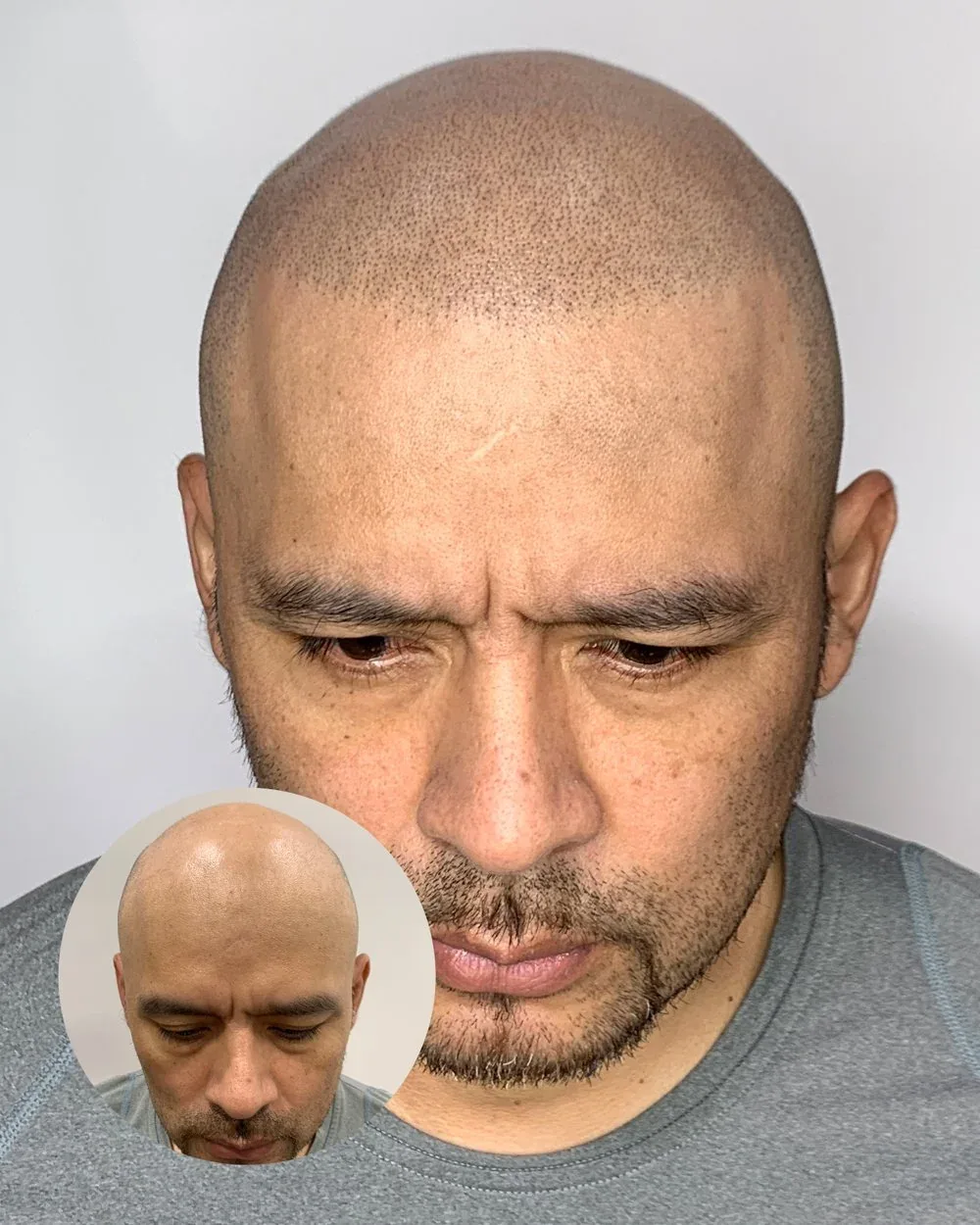 Hairline restoration before and after — male client