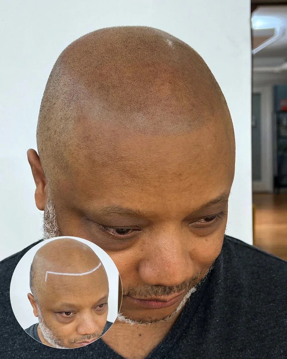Scar concealment before and after — male client