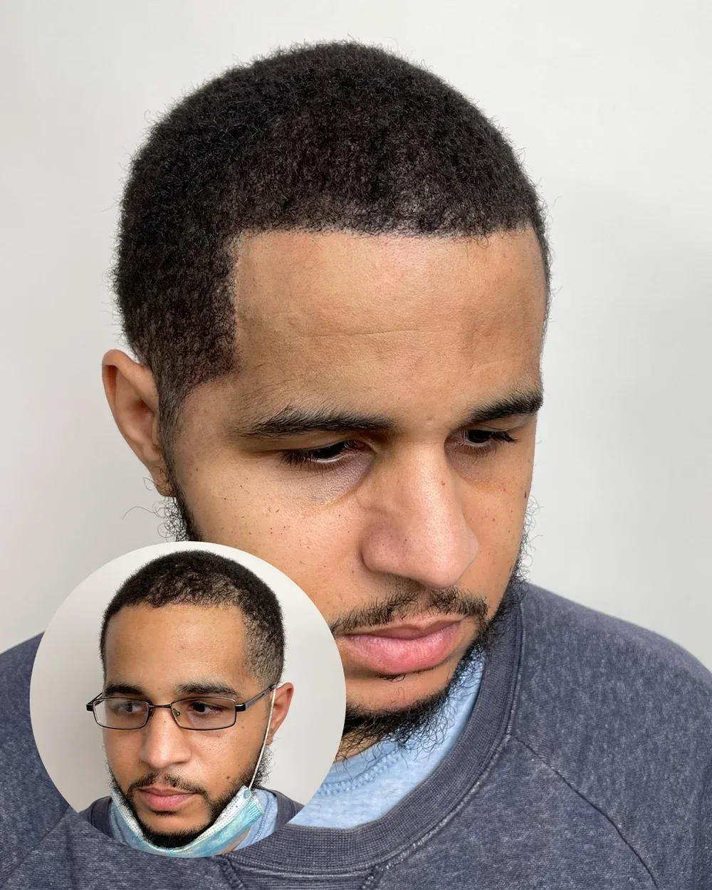 Hairline restoration before and after — male client