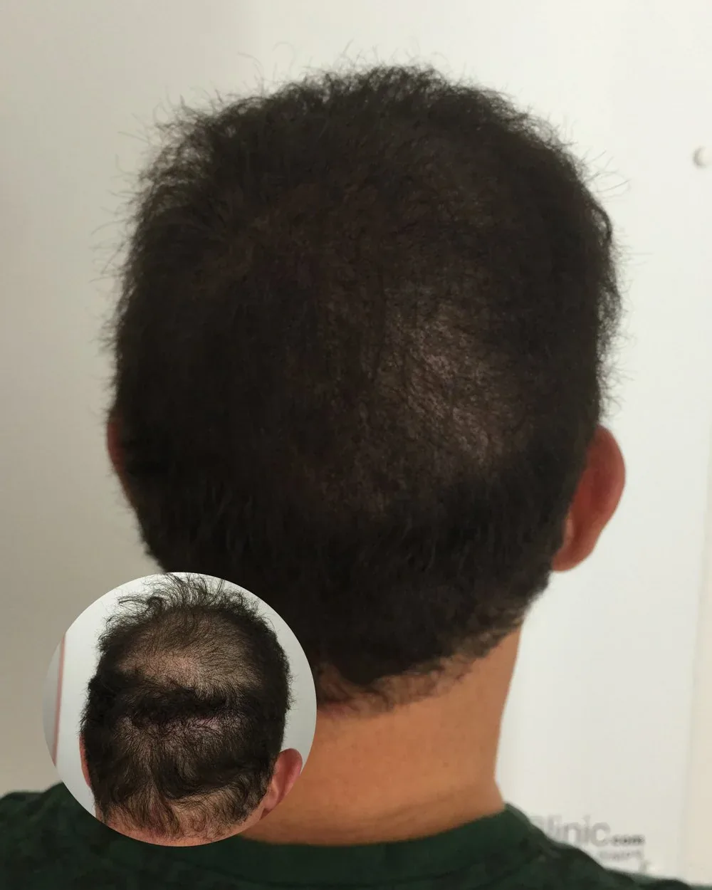 Density treatment before and after — male client