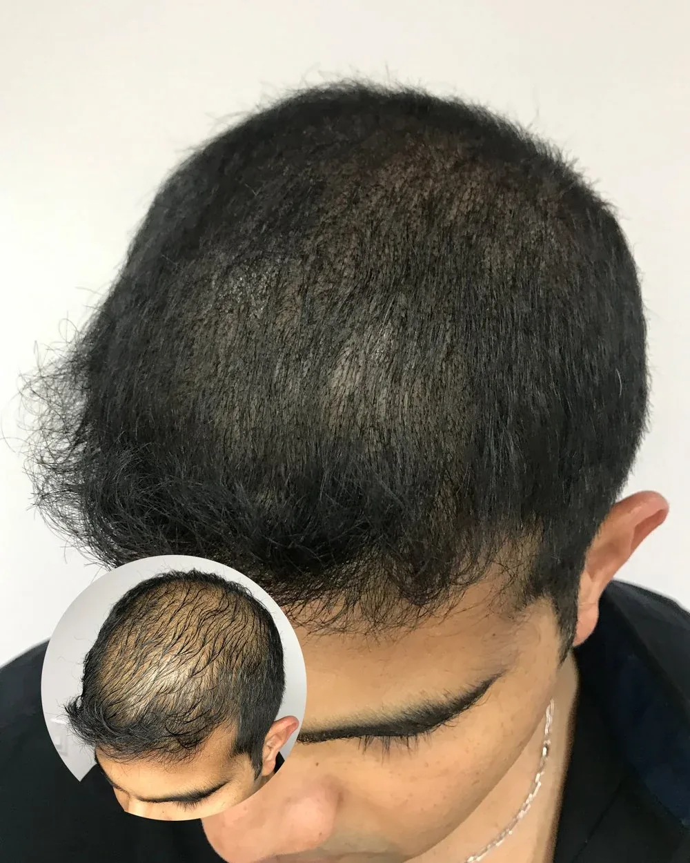 Density treatment before and after — male client