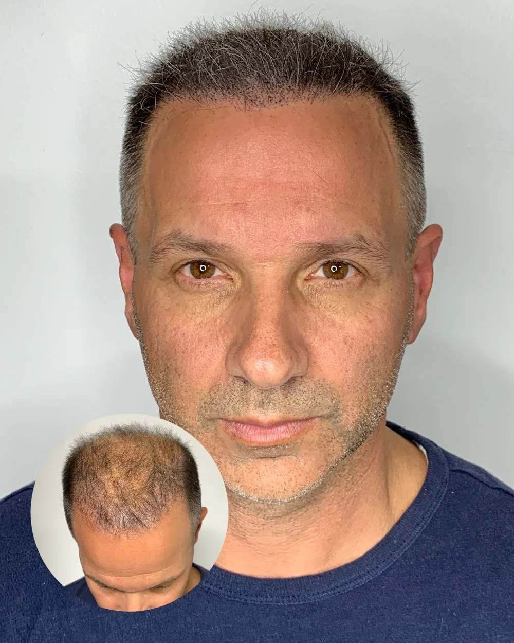 Hairline restoration before and after — male client