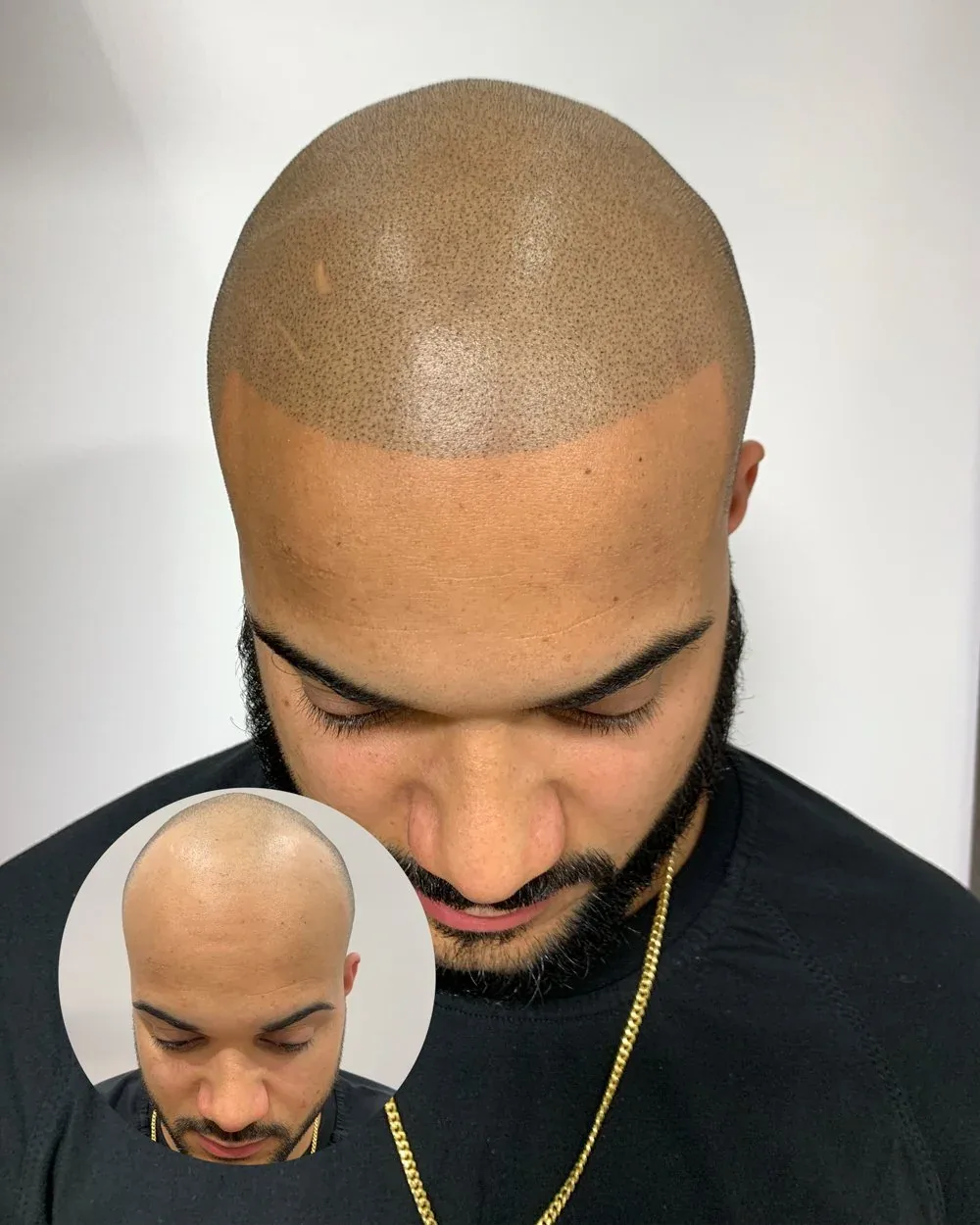Hairline restoration before and after — male client