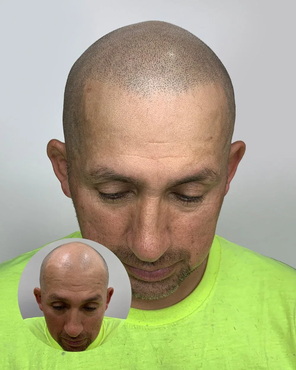 Density treatment before and after — male client