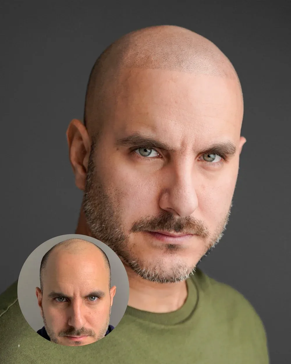 Density treatment before and after — male client