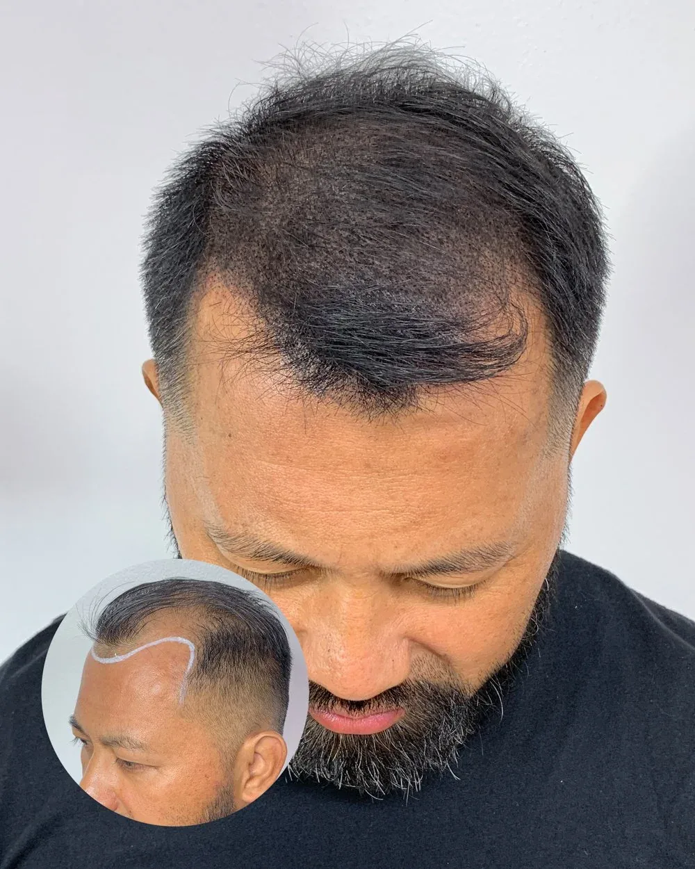 Hairline restoration before and after — male client