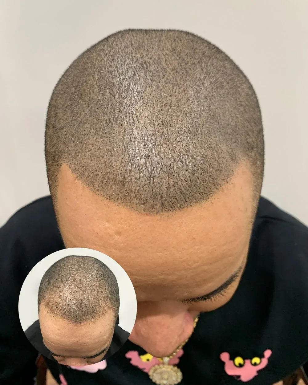 Hairline restoration before and after — male client