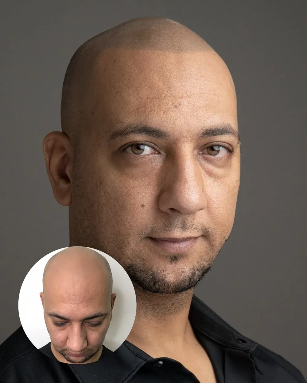 Hairline restoration before and after — male client