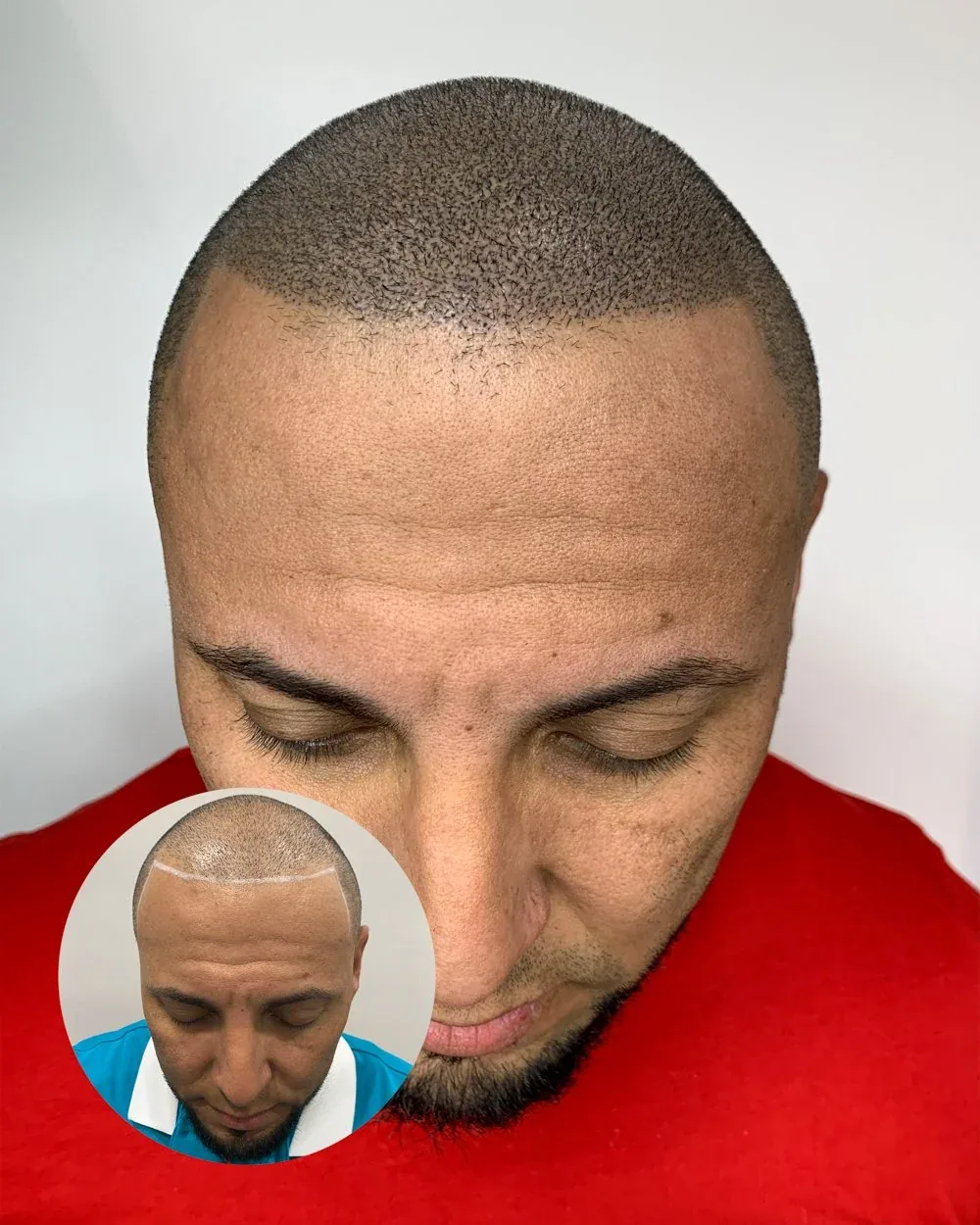 Density treatment before and after — male client