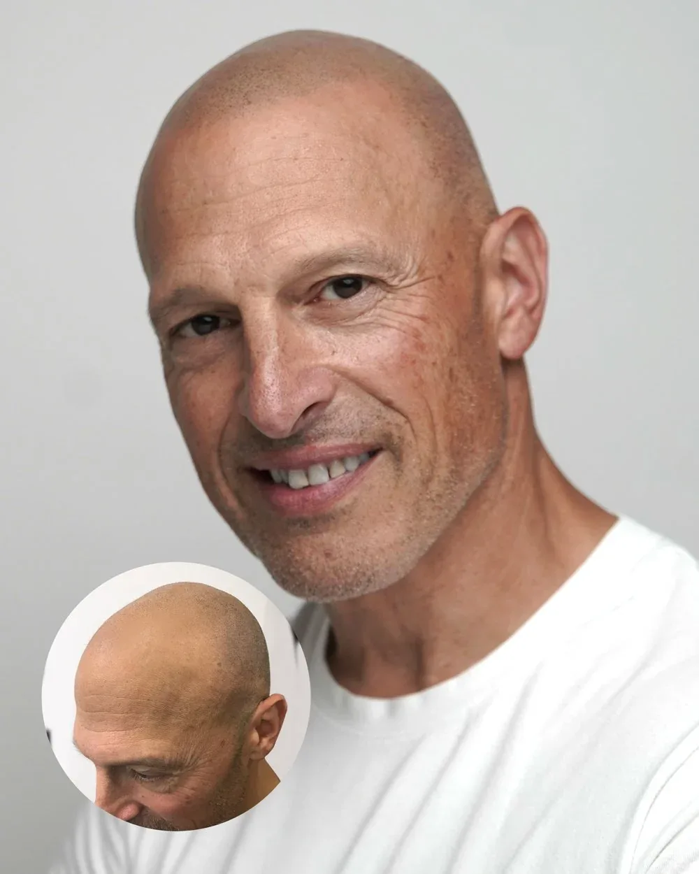 Hairline restoration before and after — male client