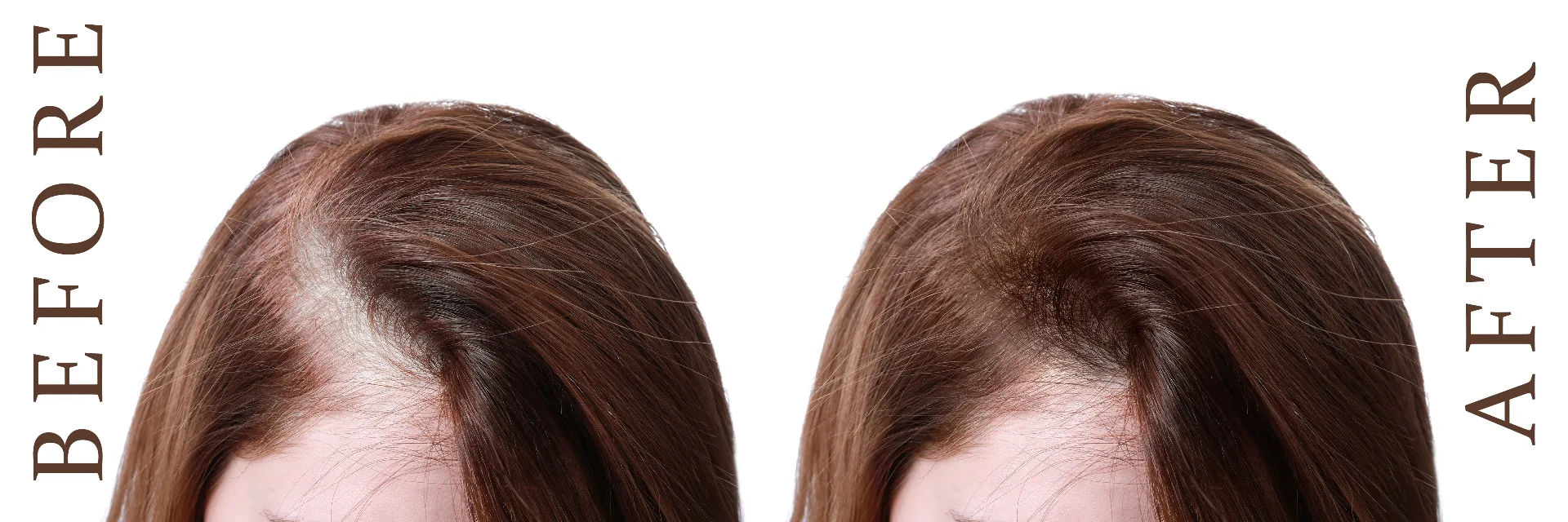 Density treatment before and after — female client