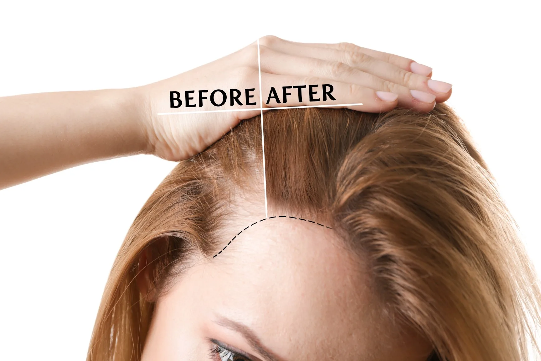 Density treatment before and after — female client