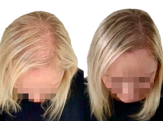Density treatment before and after — female client