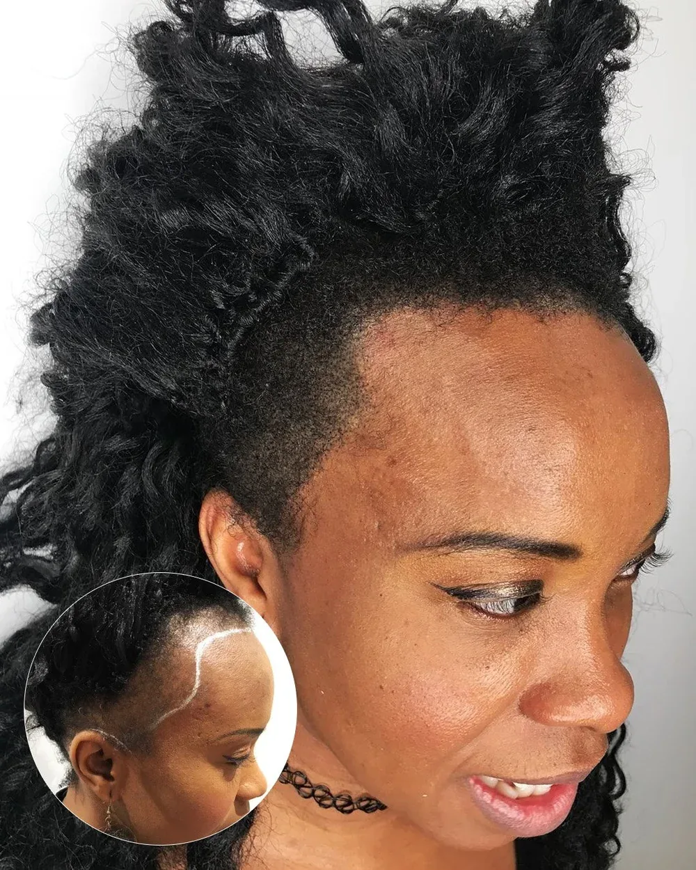Alopecia camouflage and density treatment before and after — female client