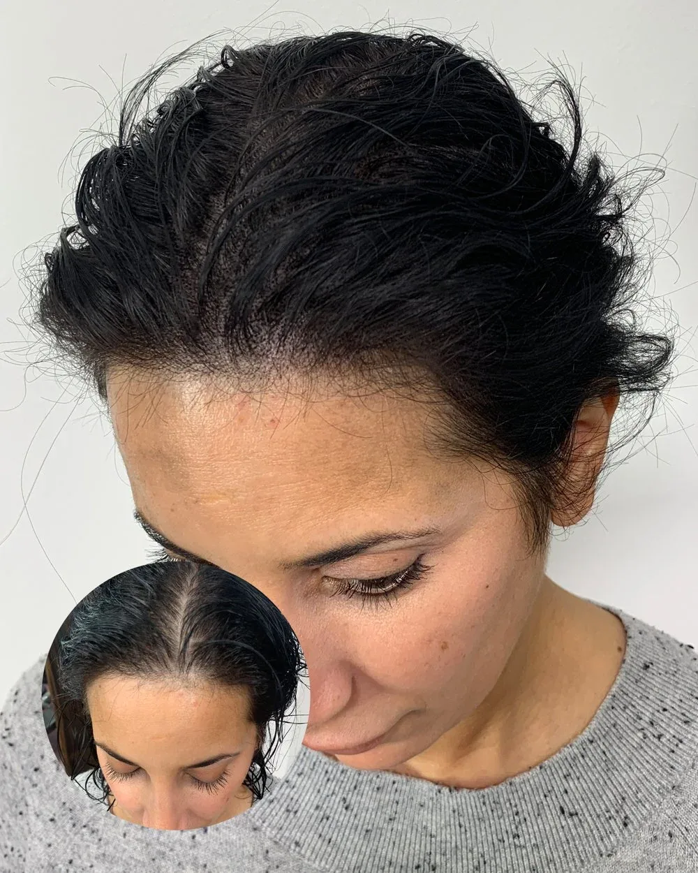Density treatment before and after — female client