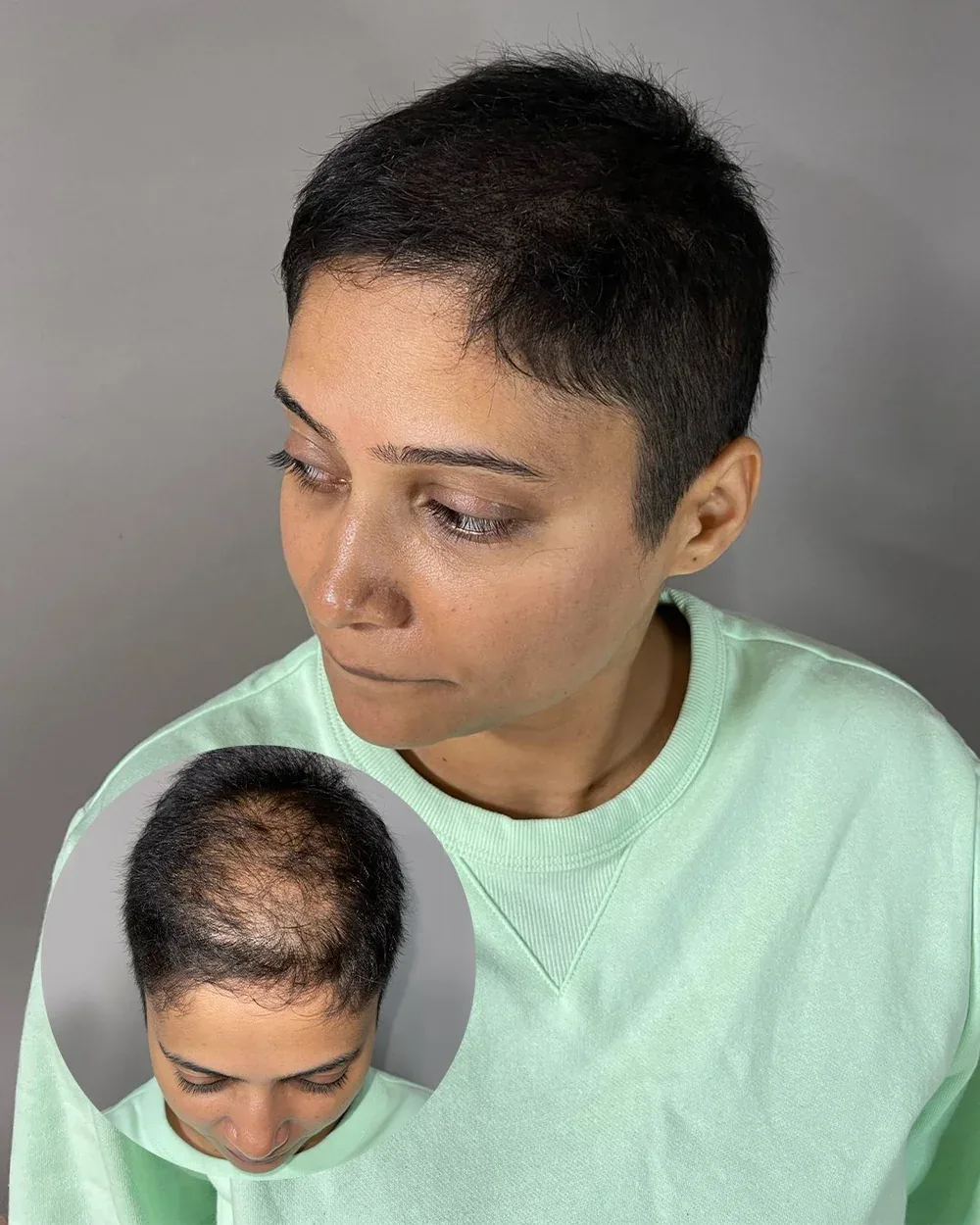 Density treatment before and after — female client