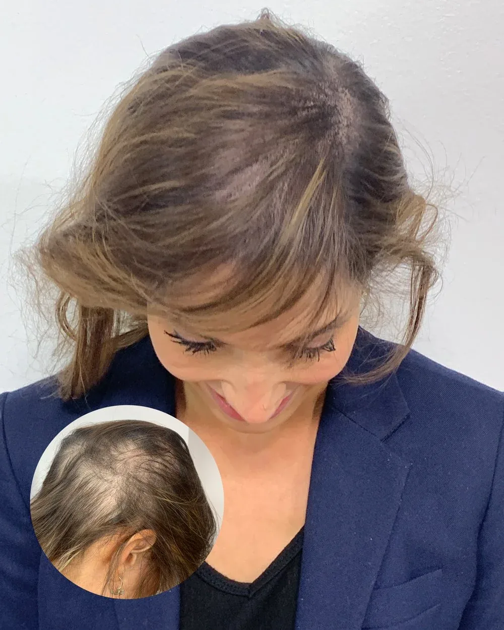 Density treatment before and after — female client