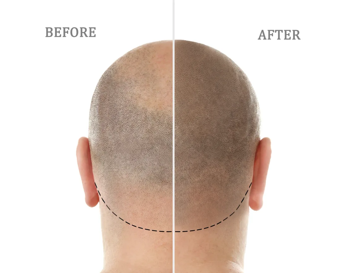 Before & after SMP hairline restoration on a male client