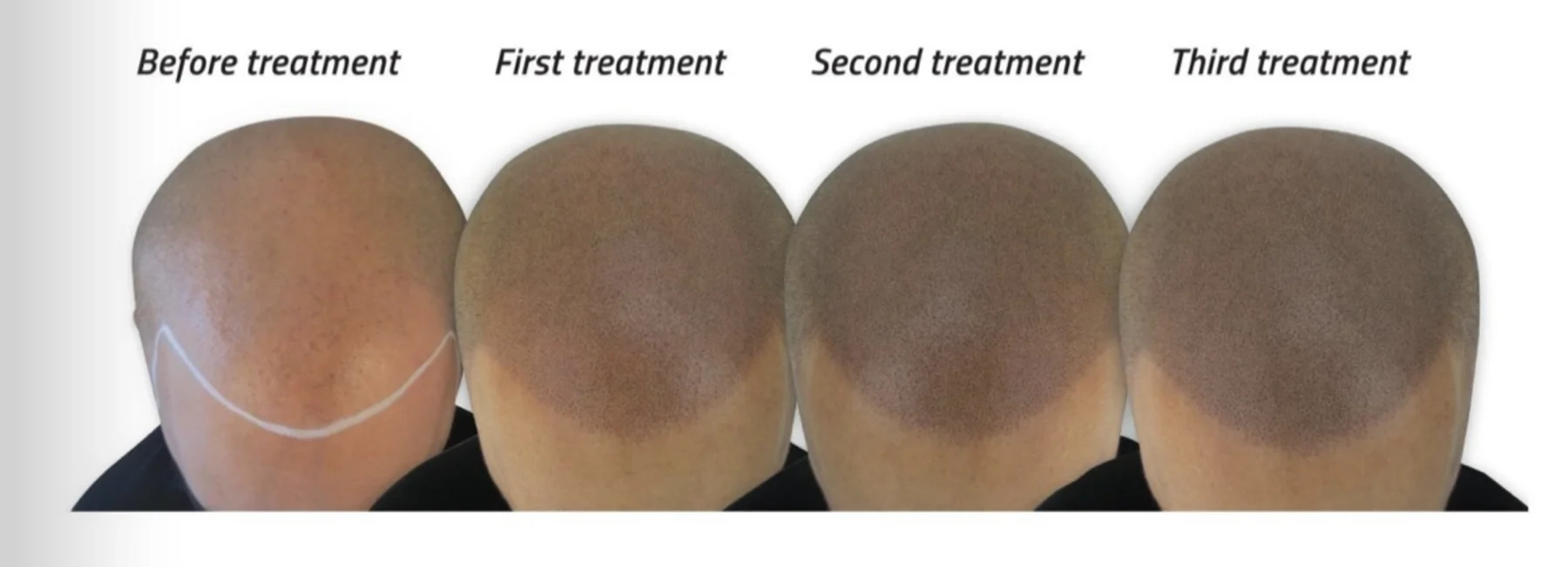 Scalp micropigmentation progress: before, first, second & third treatment