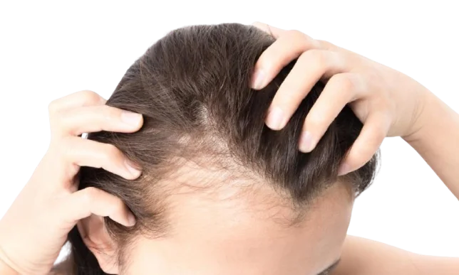 Woman showing thinning hair, considering scalp micropigmentation